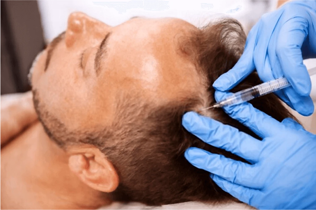 Mesoterapia Capilar