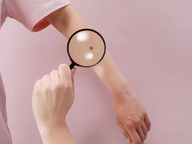 Exame de pele com lupa para avaliação de lesões