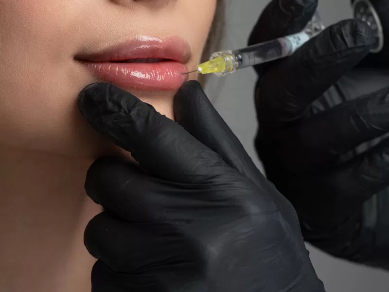 Aplicação de preenchimento labial com técnica precisa
